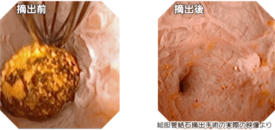 総胆管結石摘出手術の実際の映像