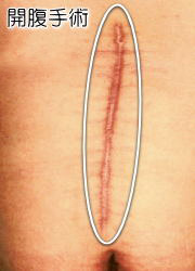 開腹手術の手術痕イメージ