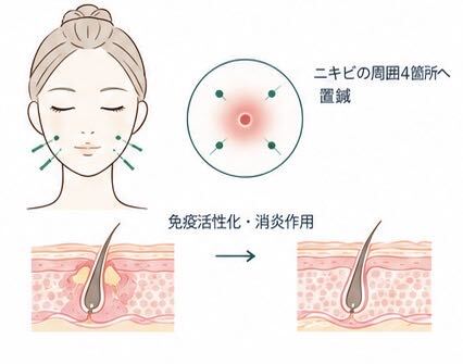 ニキビ治療