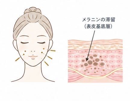 しみ